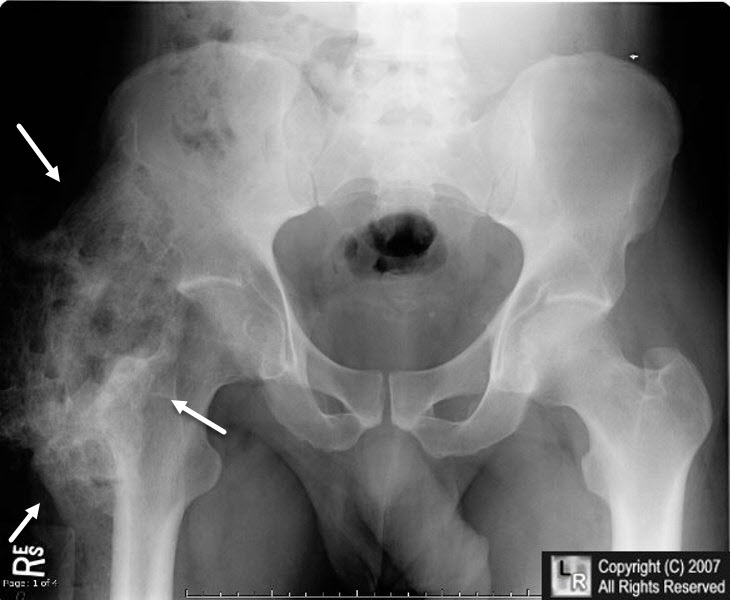 Heterotopic ossification